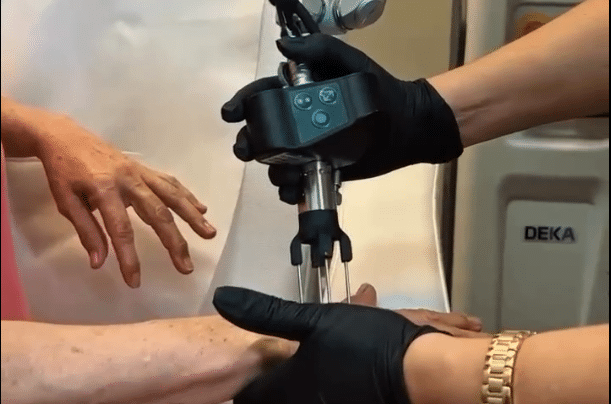 Co2 Laser Hands Procedure