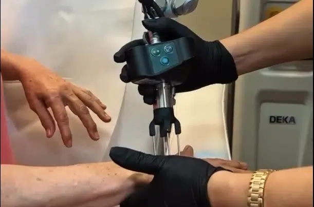 Co2 Laser Hands Procedure