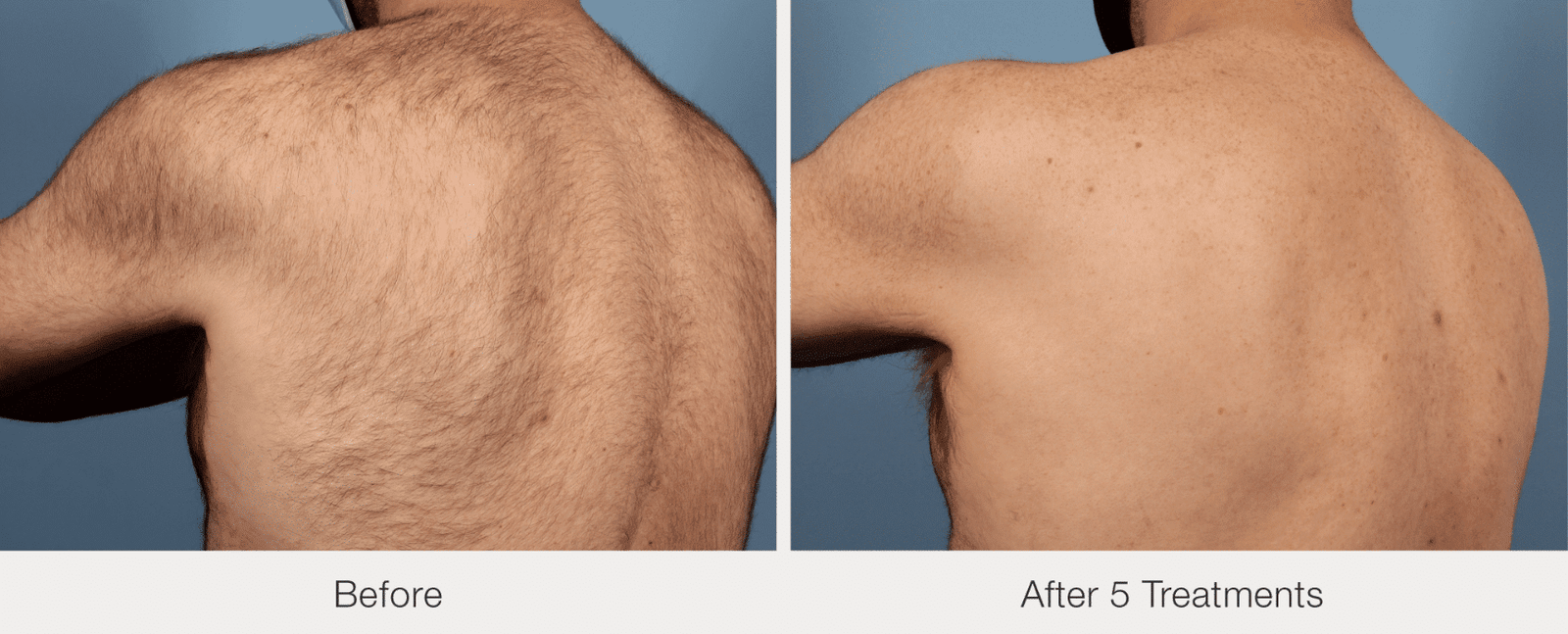 Before and after laser hair Removal