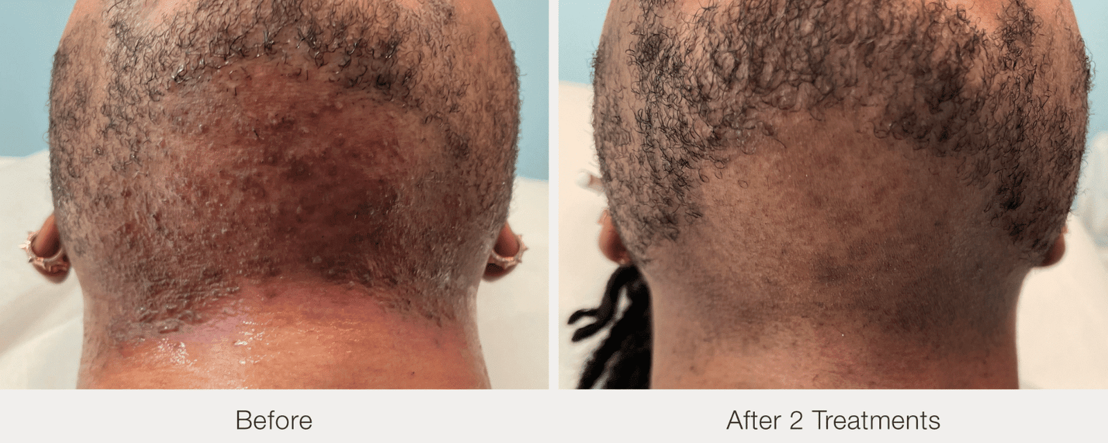 Before and after laser hair Removal