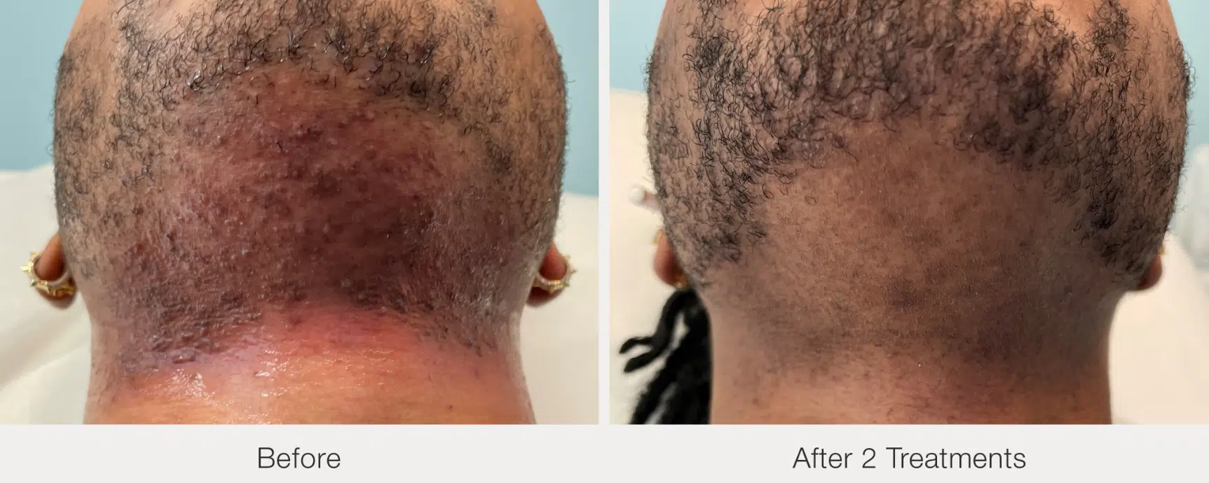 Before and after laser hair Removal