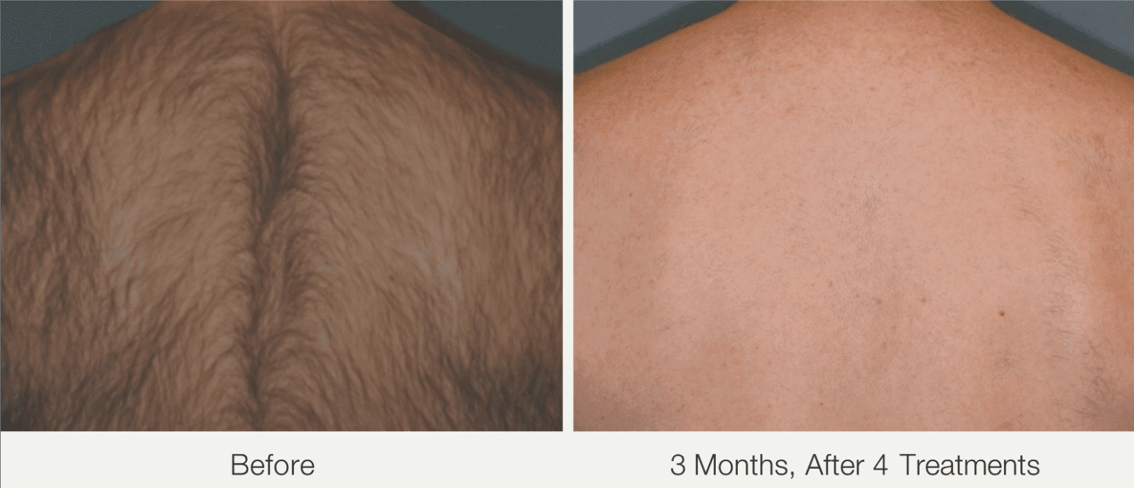 Before and after laser hair Removal