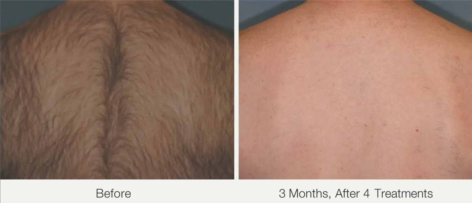 Before and after laser hair Removal