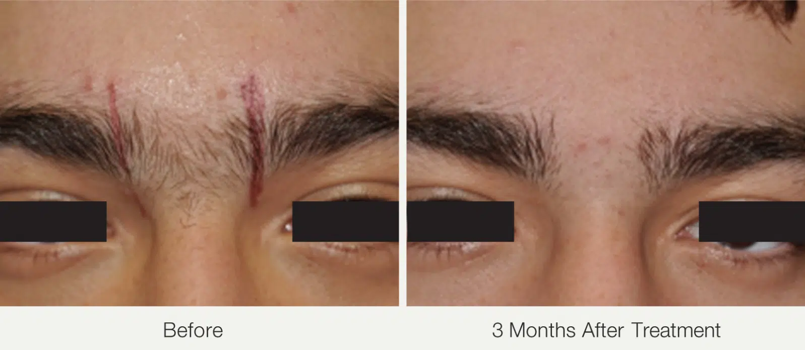 Before and after laser hair Removal